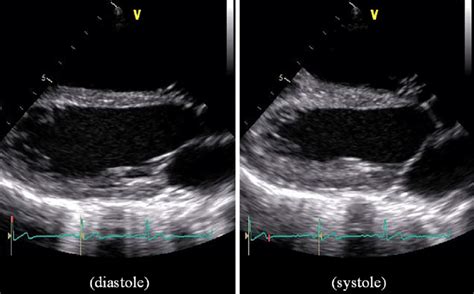 Figure3parasternal Long Axis Views In End Diastole Left Panel And