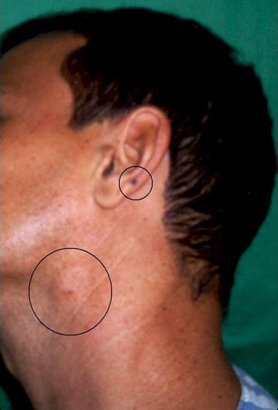 Ya hemos visto las causas del dolor cervical, ahora debemos conocer los síntomas para poder detectarlo a tiempo y poner remedio. "Pictures of ganglion cyst on foot, ganglion cysts and ...