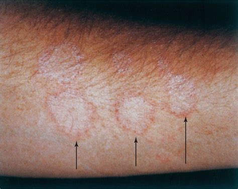 45 Dermatophytes Sporothrix And Other Superficial And Subcutaneous