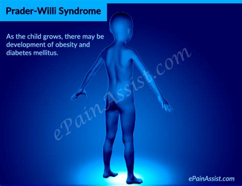 Prader Willi Syndrome Pws Causes Symptoms Diagnosis Treatment Human