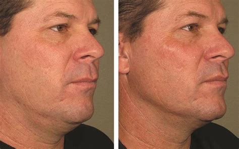 Ethos Spa Now Offers Non Surgical Botox Neck Lift