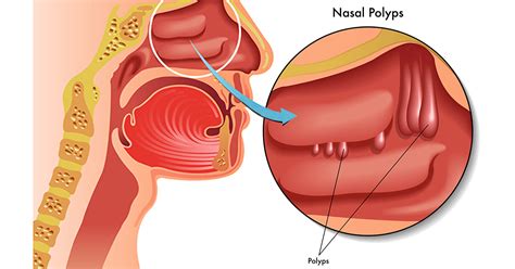 Birmingham Nasal Polyps Alabama Nasal And Sinus Center