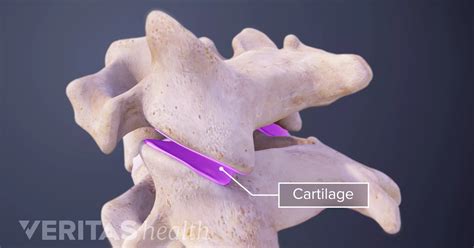 Cartilage Definition Back Pain And Neck Pain Medical Glossary