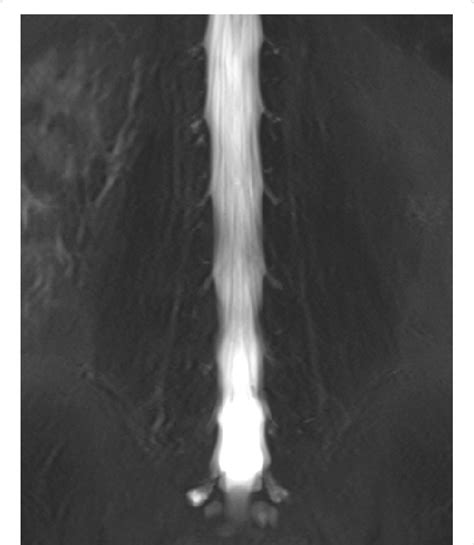 T2 Weighted Image Of The Mri Of A Patient With Left Sciatica The Left
