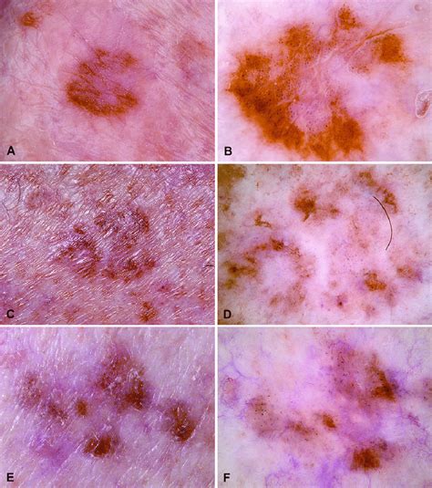 Clinical At Left And Corresponding Dermatoscopic Images At Right Of