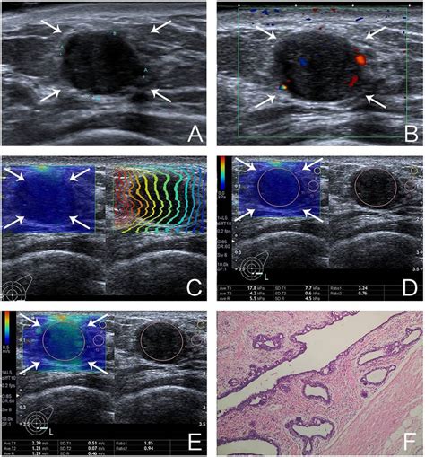 Images Of A 31 Year Old Woman With Fibroadenoma A The Lesion Is