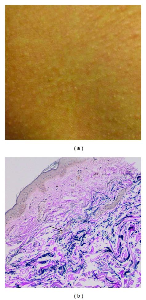 Pxe Like Papillary Dermal Elastolysis Small Flesh Colored Papules Can