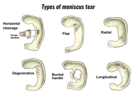 Medial Meniscus Tear Torn Meniscus Injury