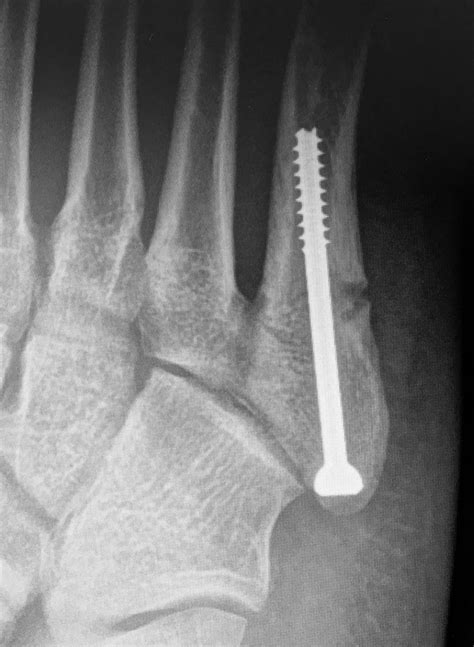 Fifth metatarsal stress fracture in elite male football players: an on