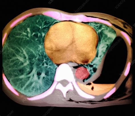 Collapsed Lung Ct Scan Stock Image M1700275 Science Photo Library