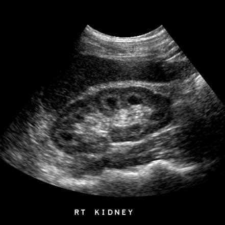Echogenic Renal Pyramids Differential Radiology Reference Article