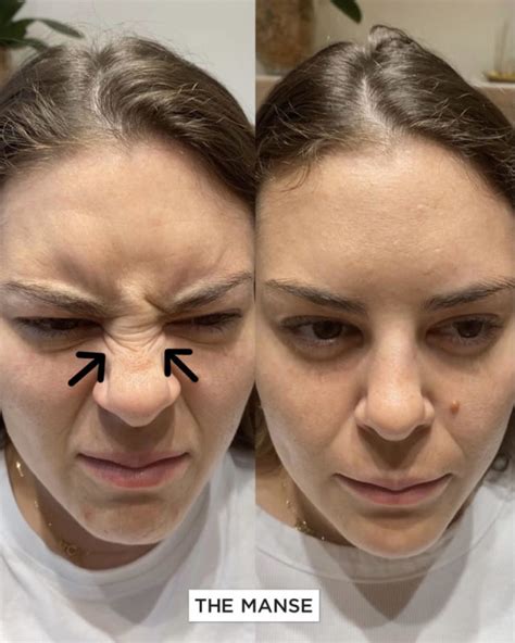 Bunny Lines On Nose Injections Best Clinic Sydney For Dermal Fillers