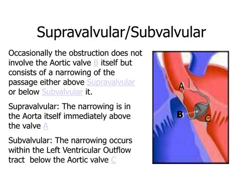 Ppt Aortic Valve Disease Powerpoint Presentation Free Download Id