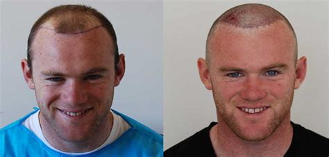 Wayne Rooney Hair Transplant Result Before And After Images Story