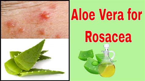 How Effective Is Aloe Vera For Rosacea Rosacea Aloe Vera Aloe