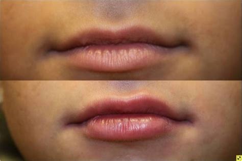 🥇 Atlanta Botox Juvederm Laser Treatment Before And After Photos