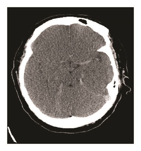 Noncontrast Head Computed Tomography Ct Showing Diffuse Cerebral