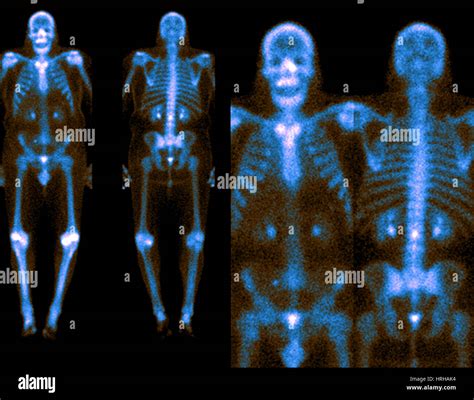 Nuclear Bone Scan Hi Res Stock Photography And Images Alamy