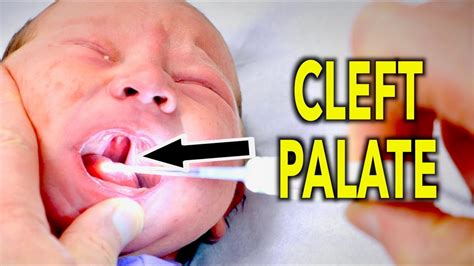Cleft Palate Newborn Dr Paul Youtube
