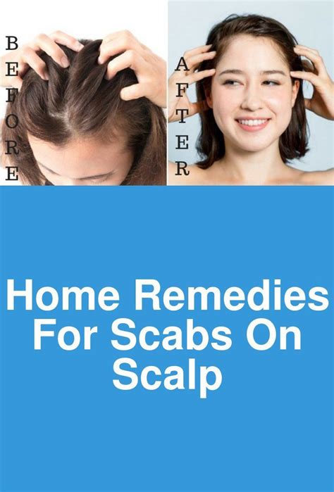 Home Remedies For Scabs On Scalp My Friend If You Are Suffering From