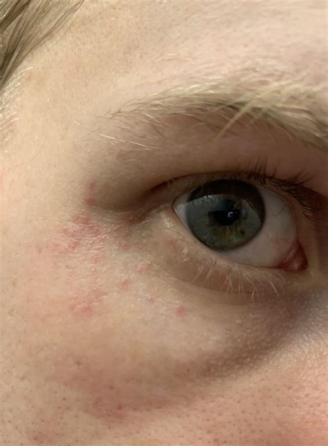 Skin Concern Small Red Bumps Around Eyes Both Sides R