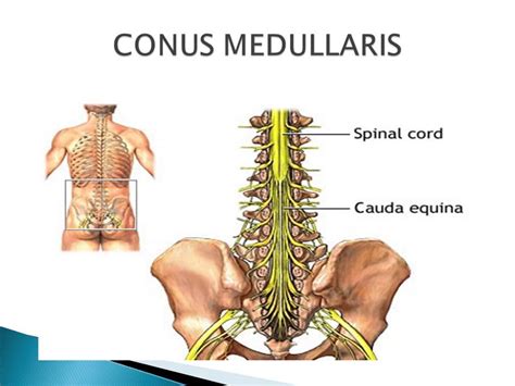 Conus Medullaris Syndrome Symptoms