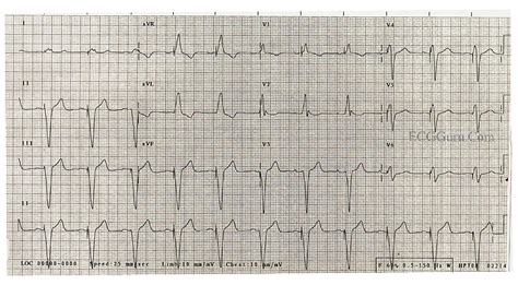 Pacemaker Rhythm Right Ventricular Pacing Triggered By Native P Waves