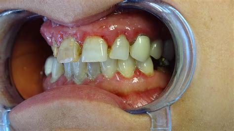 Implantologia Dentale A Carico Immediato Torna A Sorridere In 24 Ore
