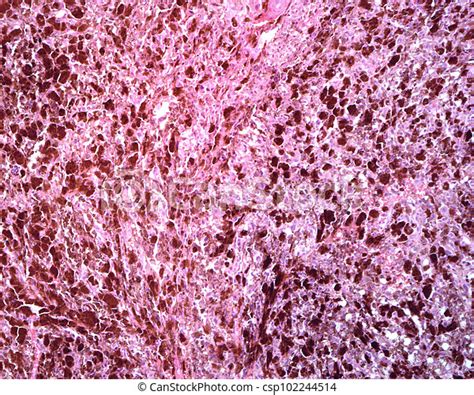 Human Lymph Node Metastasis Of Malignant Melanoma Human Lymph Node
