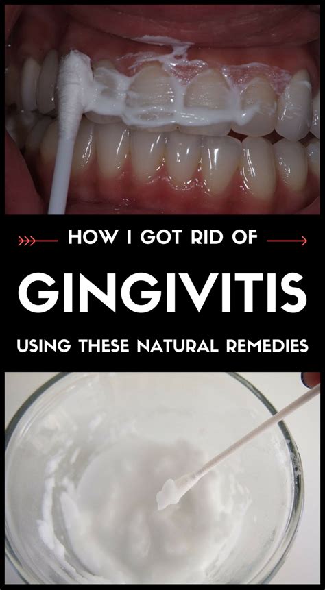How I Got Rid Of Gingivitis Using These Natural Remedies