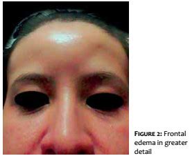 Surgical Cosmetic Dermatology Frontal Edema After Application Of