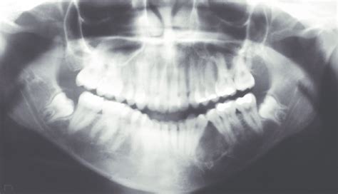 Panoramic Radiograph Displaying A Cystic Lesion Provoking Divergence Of