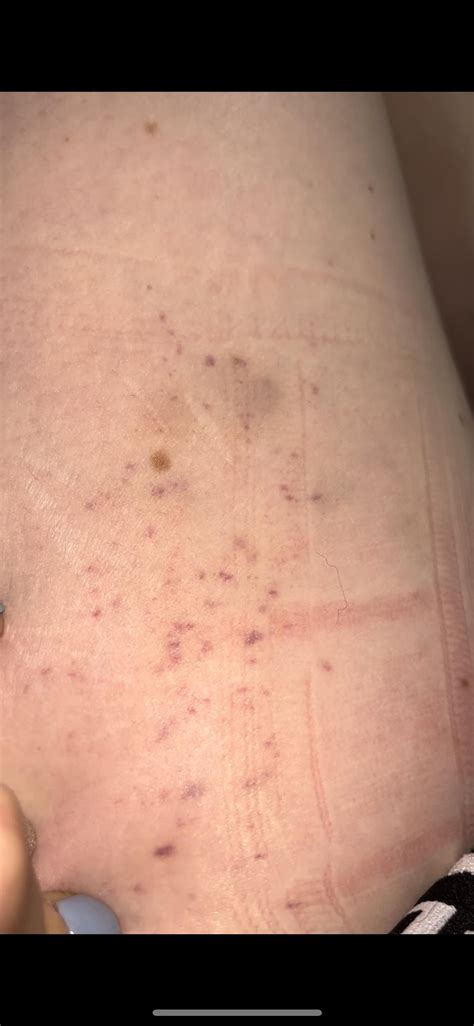 Purple Spots And Bruising On Thigh Rdermatology