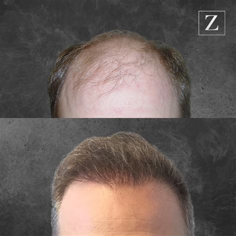 Male Hair Transplant Before And After Photos Ziering Medical
