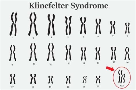 クラインフェルター症候群の症状・原因を医師が解説｜特徴を画像で紹介