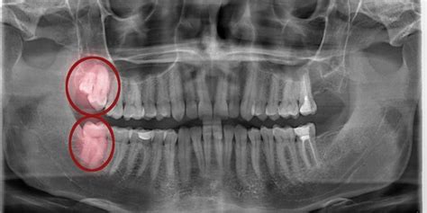 Impacted Wisdom Teeth Causes Consequences Treatment