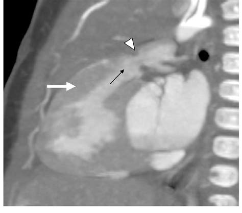 Supravalvular Pulmonary Artery Stenosis In Wbs One Monthold Girl
