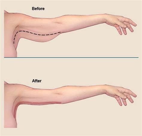 Arm Lift Before And After Photos Artofit