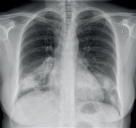 Bilateral Infiltrates In A Health Care Worker During The Covid 19