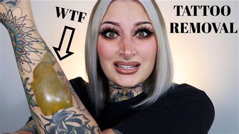 Tattoo Removal Insane Blisters Youtube