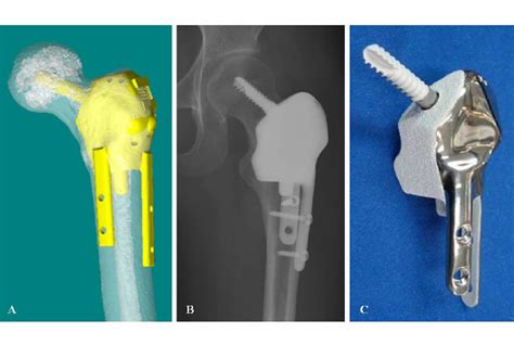 A A Joint Saving Cad Custom Prosthesis In Patient 14 With Low Grade