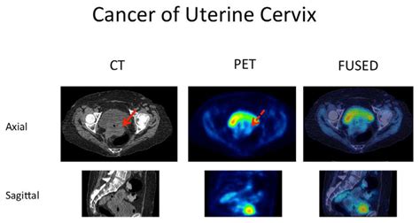 61 Year Old Female Patient With Cancer Of Uterine Cervix And A 7cm