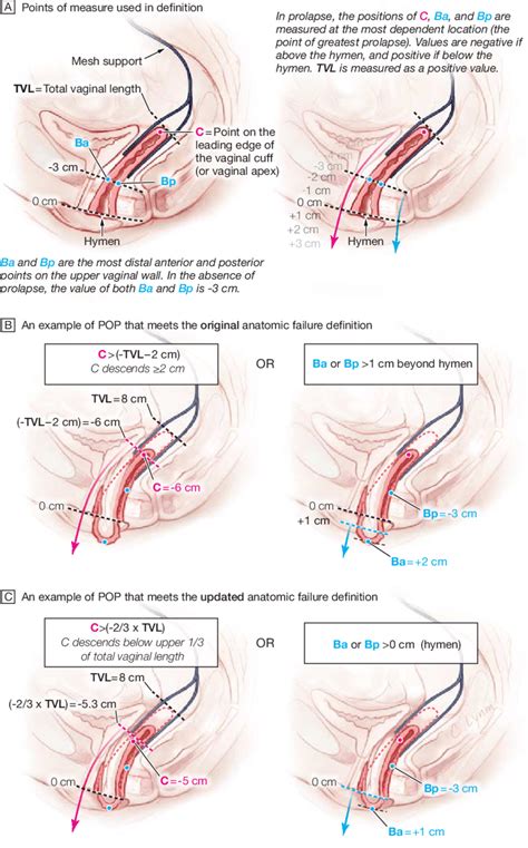 How to fix a prolapse without surgery. Pelvic Floor Prolapse Surgery Recovery Time | Review Home Co