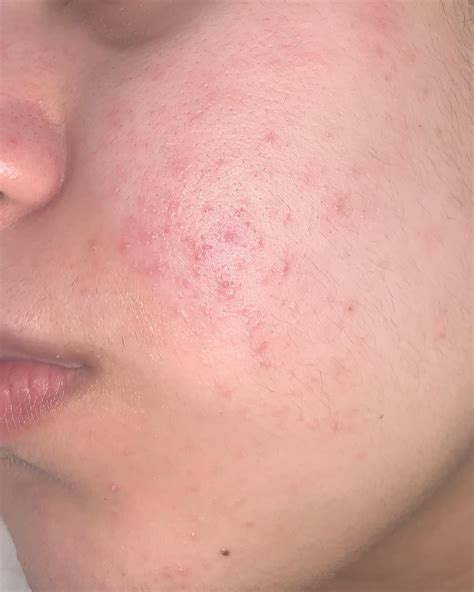 Does Anyone Know What Is Causing These Spots I Get Them On My Chin