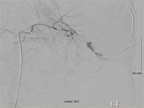 Angiogram Of The Spleen Showing Distal Splenic Artery Contrast