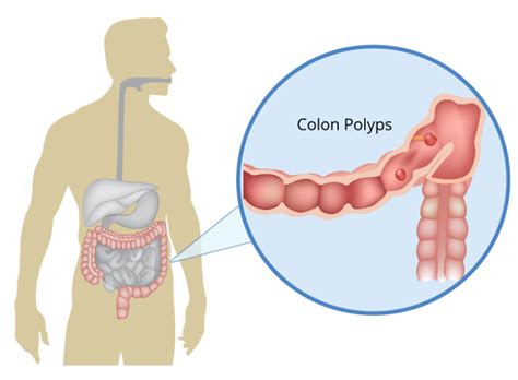 what does a colon polyp look like