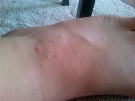 Dale prokupek, md x dieer artikel wurde von dale prokupek, md, verfat. Hautausschlag am Fuß (Füße, Ausschlag, Dermatologie)