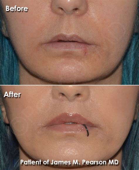 Corner Lip Lift Dr James Pearson Facial Plastic Surgery