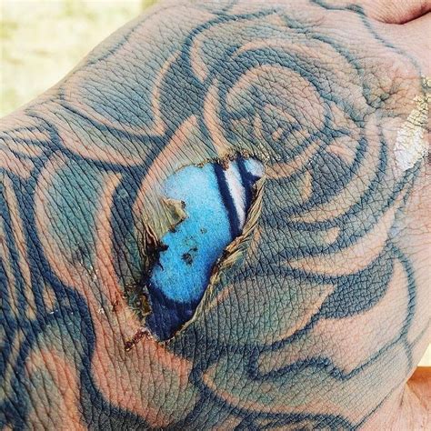 Epidermal Burn Of The Hand Exposes Bright Colors Of Tattoo Ink Embedded