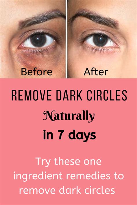 One Ingredient Remedies To Remove Dark Circles Naturally In 7 Days Try